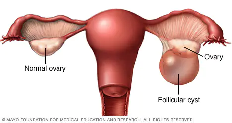 Ovarian cysts